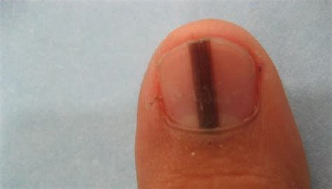 Linha Preta Na Unha Como Tirar - O que significa uma linha preta na unha? – Fatos Desconhecidos