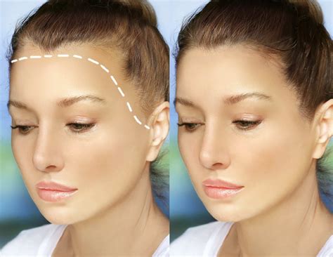 Frontal Fibrosing Alopecia Depression Of The Frontal Veins: A New