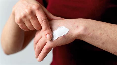 Effective psoriasis treatment options & self-care strategies – Dr.JRK's ...