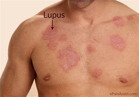 Discoid lupus erythematosus - Cyprus Dermatology Clinic