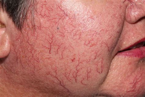 Telangiectasia & hemorrhagic telangiectasia causes, diagnosis & treatment