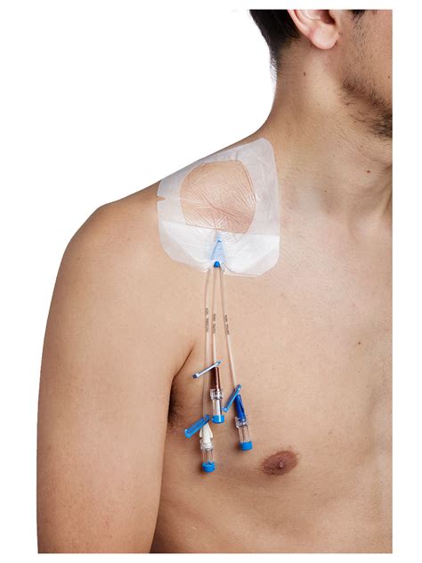 dialysis port  chest