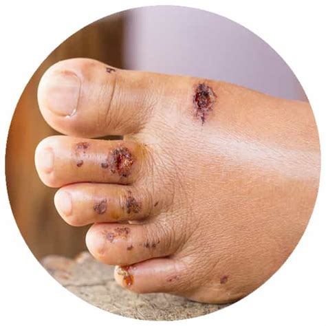 wound care questionnaire immersion health