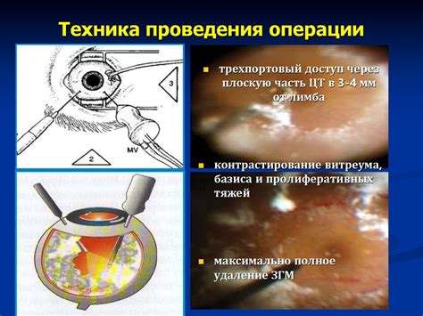 Сосудистая оболочка глаза - презентация онлайн