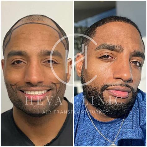 eminem beard transplant facial hair transformation analysis