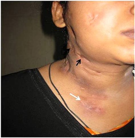 How Big Are Swollen Lymph Nodes In Hiv at Annabelle Wang blog