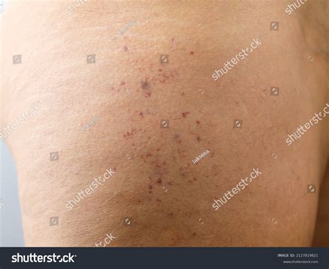 groups red spots petechiae  thigh stock photo  shutterstock