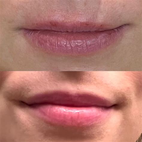 Lip Flip Before and After: A Botox Favorite - Grace in the Grind