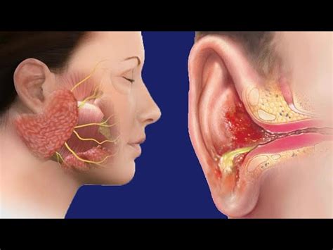 Posterior Auricular Lymph Nodes Swollen