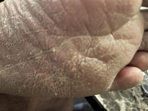 Scaly skin on bottom of feet : r/AskDocs