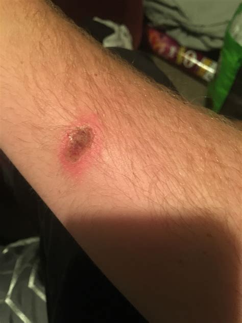 What Do Brown Recluse Spider Bites Look Like Brown Recluse Spider ...