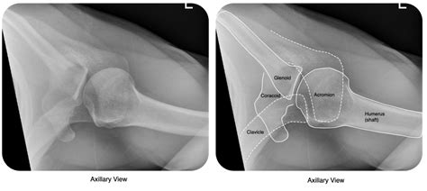 Shoulder Dislocation – OrthoSHO