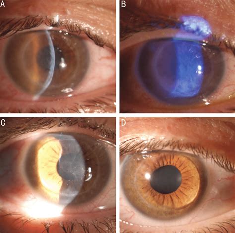 Slit-lamp images of corneal graft after PRK A, B: 5d after PRK: diffuse ...