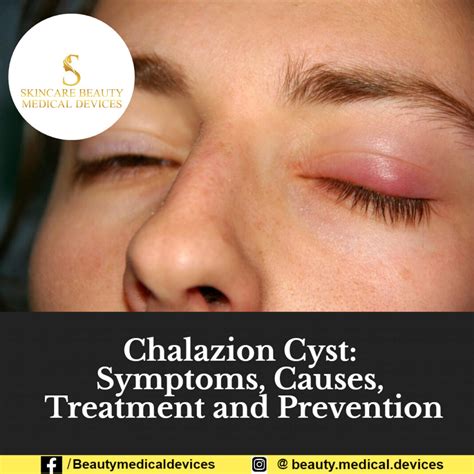 Chalazion Cyst: Symptoms, Causes, Treatment and Prevention