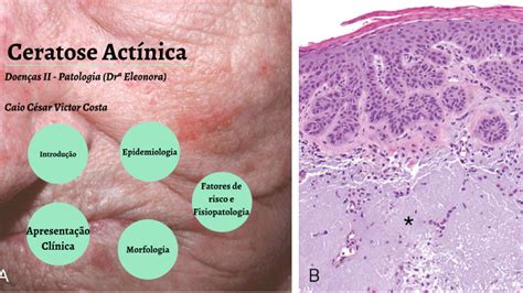 O Que É Ceratose Actínica - Histologia De Ceratose Actinica Queratose Actínica Palpebral