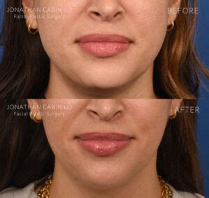 Non-Surgical Facial Slimming - CabinMD Facial Plastics & Aesthetics