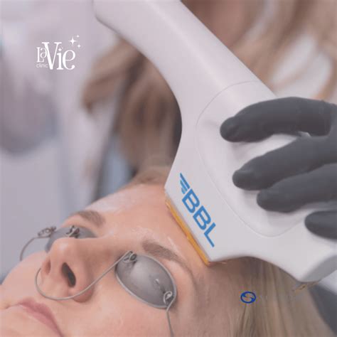 BBL Laser Treatment | La Vie Clinic - Rochester Hills