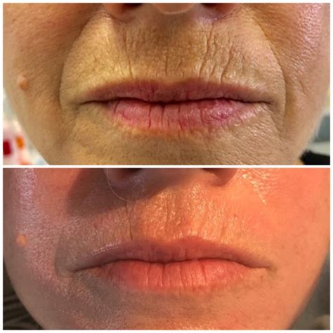 Angel Lift Before and After: Real Customer Transformations and Reviews