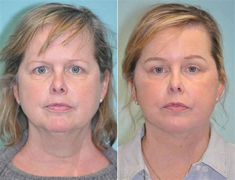 Brow Lift Surgery in Virginia & Maryland | The Naderi Center