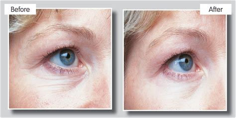 Cheshire Lasers - Omnilux LED Light Therapy in Middlewich.