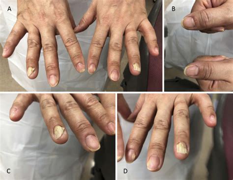 Plummer's Nails (Onycholysis) in a Thyroid-stimulation-blocking ...
