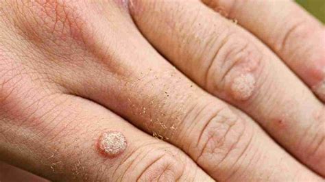 Skin Cancer Or Benign Wart? How To Identify Cancerous Warts