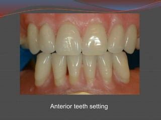 setting anterior teeth complete denture pptx