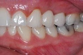 Advanced Dental | Porcelain Fixed Bridges in Las Vegas