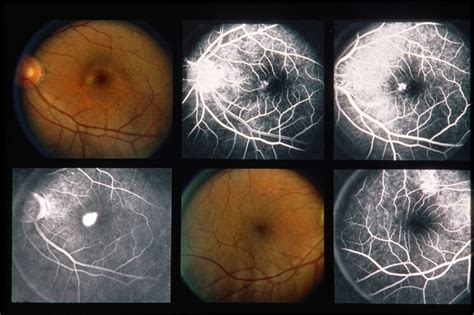 Central Serous Retinopathy - Retina Image Bank