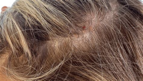 Couro Cabeludo Dolorido E Queda De Cabelo - Feridas no Couro Cabeludo: Causas Comuns e Soluções
