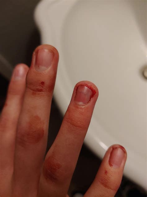 My son took a baseball to his hand today. Pulled the nail up. : r/medizzy