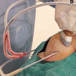 Cryoablation of bone metastasis (the solitary metastasis in the distal ...