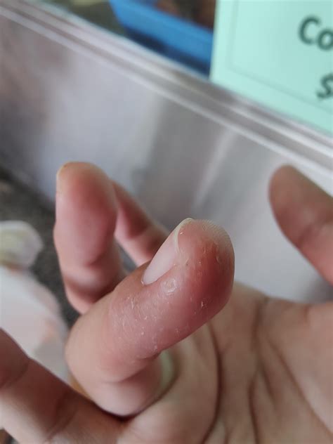 super itchy finger : r/Dermatology