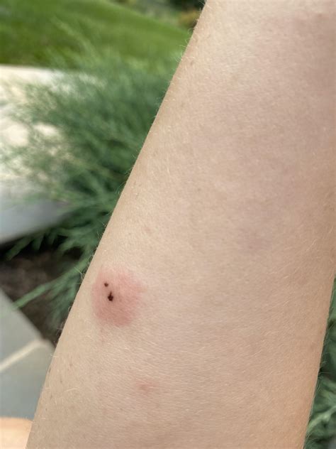 Identifying Brown Recluse Bite