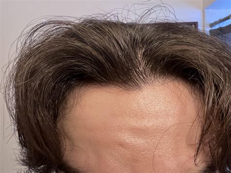 men are sharing their best tips for hair thinning at hairline male 37