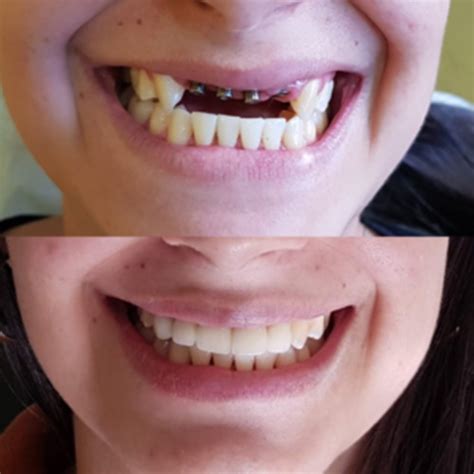 Implante Dentário Antes E Depois - Implante dentario: Antes e depois