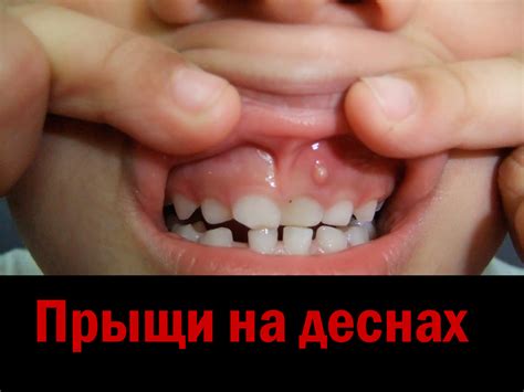 Прыщи на деснах во рту: виды, 14 причин с фото, и лечения