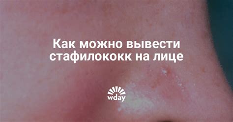 Стафилококк на лице: причины появления и способы удаления | WDAY