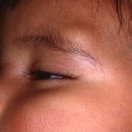 angular dermoid cyst   left supraorbital ridge