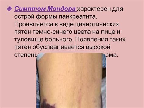Семиотика острого панкретатита