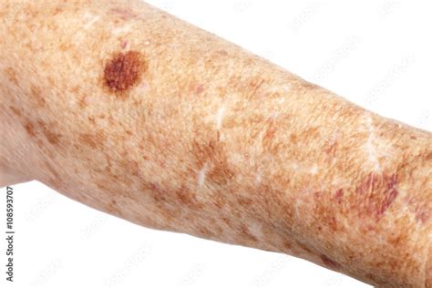 Female senior citizen arm with age spots (also known as liver spots ...