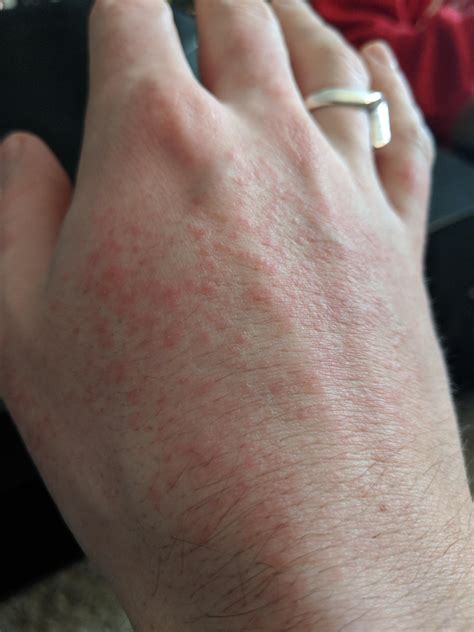 Itchy Rashes On Hands