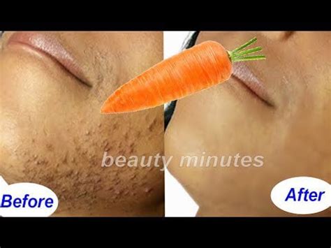 how to get rid of hair under skin