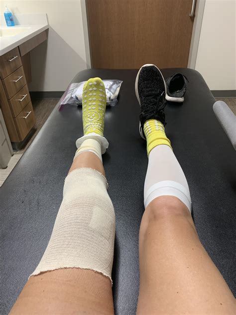 Day 1 Post-Op: swelling isn’t too bad, slept through the night other