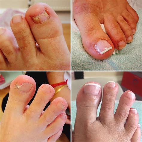 Fake Nails And Toenails at Kenneth Locke blog