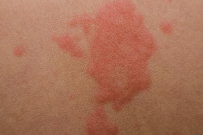 COMMON CAUSES OF RASHES - Dermatology Associates of Tigard