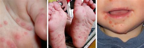 Hand, Foot, and Mouth Disease