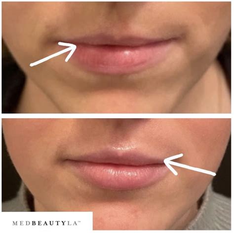 Natural-Looking Lip Filler Before and Afters - MedBeautyLA