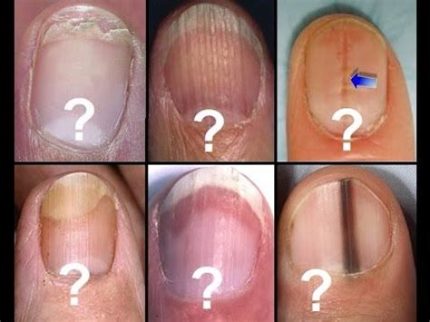 YouTube | Engle | Ongles, Ongles striés et Ongles striés causes