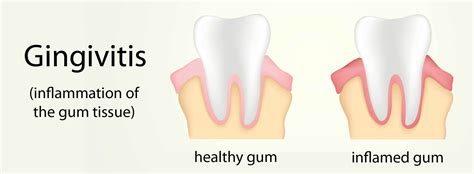 Gingivitis Treatment by Dr. Marichia Attalla DDS, PC